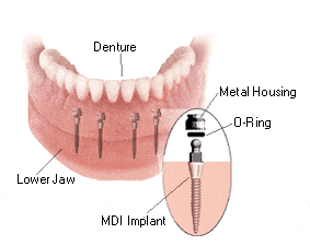 Dentaduras en Union-City-NJ-Affordable-Dentures-Diana-Rodriguez-DMD-Fix-On-Six-Implant-Supported-Dentures.
