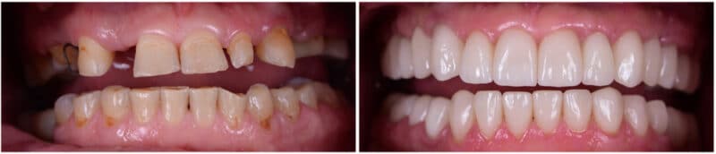 Full Mouth Dental Implants in Union City, NJ | Diana Rodriguez, DMD - Full,Mout,Recovery,By,Press,Ceramic,Crowns,And,Implants