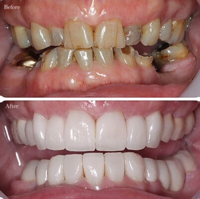 Implantes dentales en toda la boca en Union City, NJ Diana Rodriguez, DMD - Antes,y,Después,de,arreglar,los,dientes,nuevos,para,el,paciente