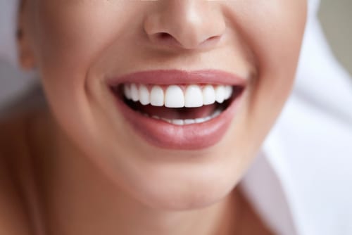 Porcelain Veneers in Union City, NJ Diana Rodriguez, DMD - Healthy,White,Smile,Close,Up.,Beauty,Woman,With,Perfect,Smile,