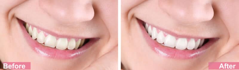 Blanqueamiento dental en Union City, NJ Blanqueamiento Diana Rodriguez, DMD - Primer plano,de,los,dientes,de,una,mujer,sonriente,antes,y,después,del,blanqueamiento - Primer plano,de,una,mujer,sonriente,antes,y,después,del,procedimiento,de,blanqueamiento,dental