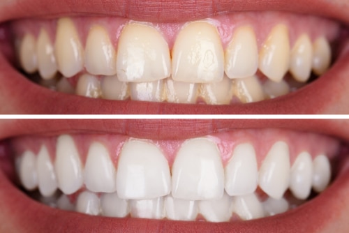 Teeth Whitening in Union City, NJ Bleaching Diana Rodriguez, DMD - Close-up,Of,A,Smiling,Woman's,Teeth,Before,And,After,Whitening