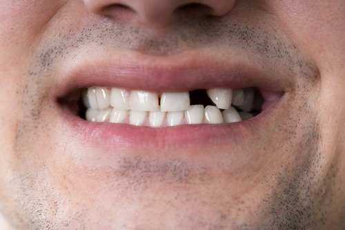 Cuánto cuestan los mini implantes dentales Dentista de Union City
