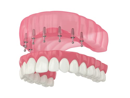 Las prótesis dentales Snap-On reemplazan los dientes perdidos Dentista de Union City