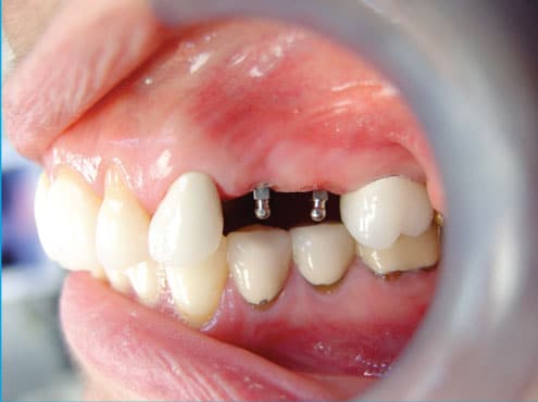 Beneficios de los mini implantes dentales explicados | Diana Rodriguez, DMD