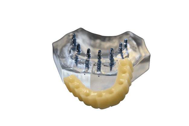 Costo de los implantes dentales explicado por el dentista de Union City, Nueva Jersey