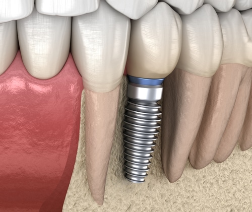 Implantes Dentales en Jersey City | Diana Rodriguez y Asociados