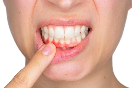 Gum Disease | Facts & Prevention | Diana Rodriguez & Associates