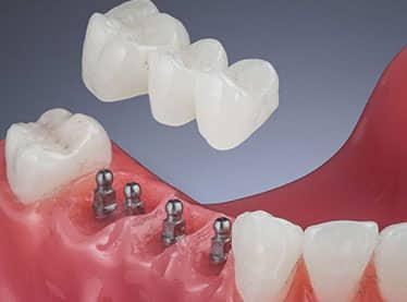Mini Implant Dentist | Mini Dental Implant Centers | Union City NJ
