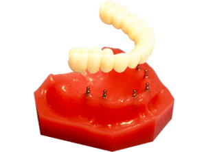 Mini Implantes | Opción de reemplazo dental | Union City N.J.