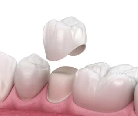 Coronas en el mismo día vs. Coronas de laboratorio | Union City Dentist 