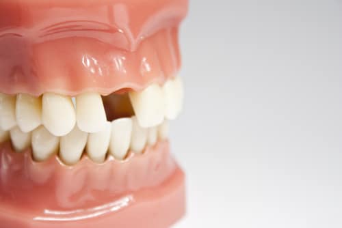 Opciones de reemplazo de dientes | New Jersey Implant Dentist