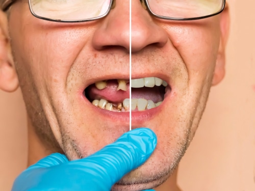 El dentista de implantes de Union City restaura sonrisas en Nueva Jersey
