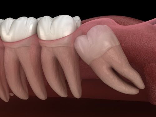 Wisdom Tooth Extraction in Union City, New Jersey | Call Today!