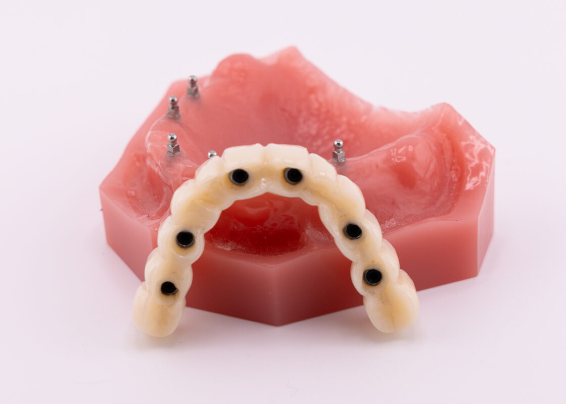 Mini Implants Cost Explained Diana Rodriguez & Associates