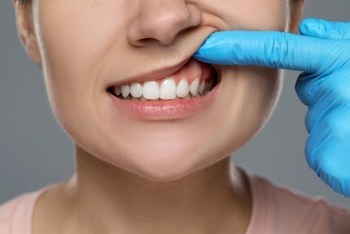 Signs of Gum Disease in Union City, NJ | Free Consultations