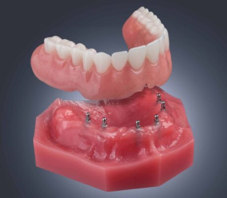 Estabilización de Dentaduras en Union City, NJ | Mini Implant Dentures