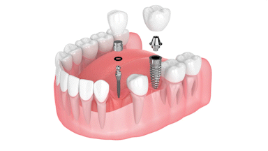 Alternativas ClearChoice | Mini Implantes Dentales en Union City, NJ