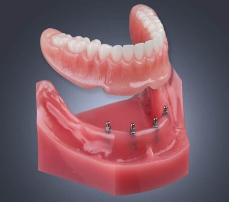 Snap-On Dentures Cost in Union City, NJ | Mini Dental Implants