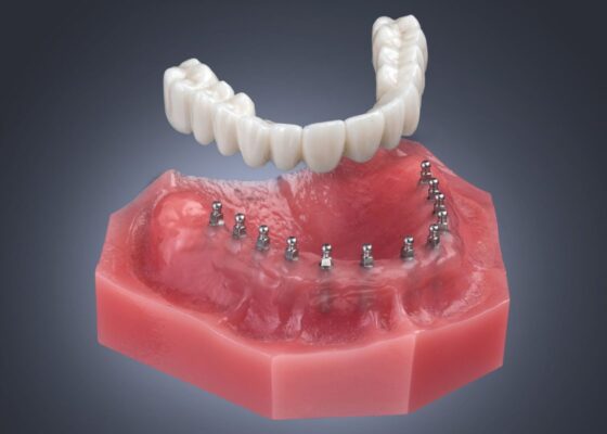 Mini Implant Dentures in Union City, NJ | Book a Free Consultation