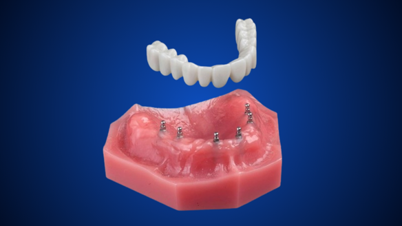 Overdentures in Union City, NJ | Ask Us About Mini Dental Implants