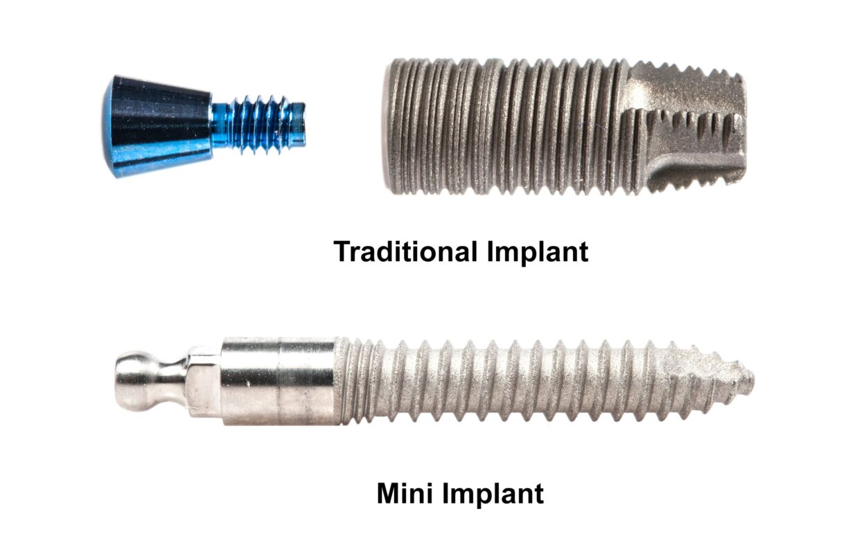 Mini Implantes vs. Implantes Tradicionales en Union City, NJ | Dientes Nuevos