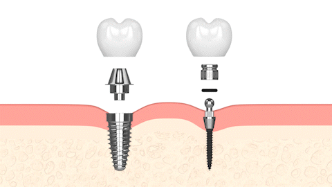Mini Implantes Dentales en Essex County, NJ | Consultas Gratuitas