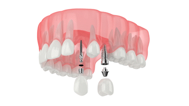 Mini Dental Implants in New York County, NY | Free Consultations