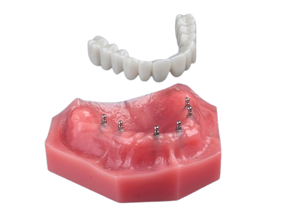 Implant Dentures Review in Union City, NJ | Fix-on-Six