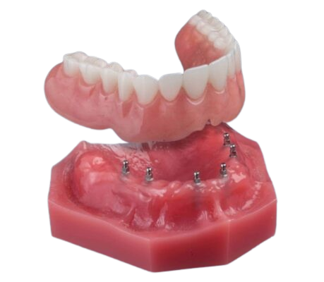 Implant Dentures Review in Union City, NJ | Overdenture