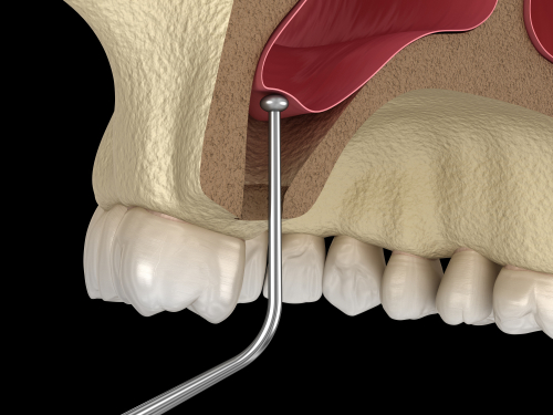 Sinus Lift Explained | Mini Dental Implants in Union City, NJ