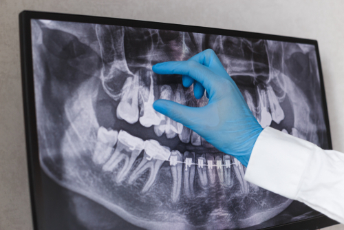 Full-Mouth Reconstruction in Union City, NJ | Free Consultations