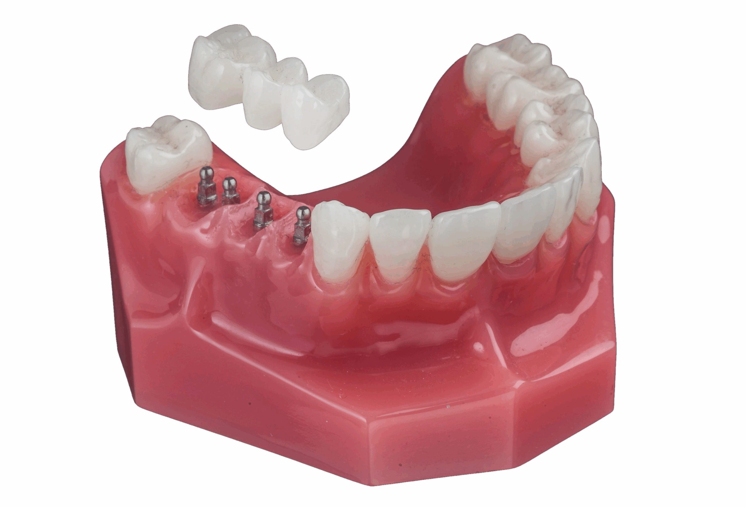 Puente Fijo en Union City NJ | Reserve una consulta GRATIS