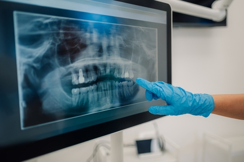 Full Mouth Extraction in Union City, NJ | Book a Free Consultation!