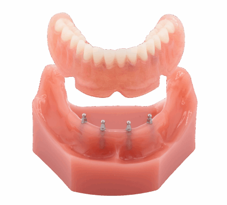 Snap-In Dentures in Union City, NJ | How Mini Dental Implants Stabilize Loose Dentures | Understanding Denture Alternatives | Diana Rodriguez & Associates