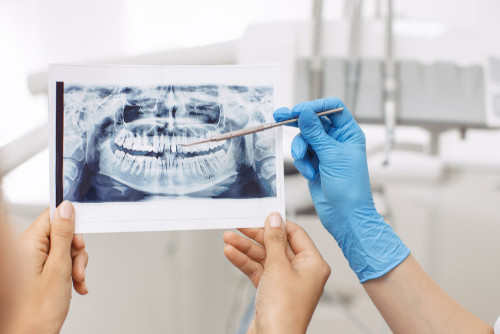 Total Mouth Extraction in Union City, NJ | Free Consultations