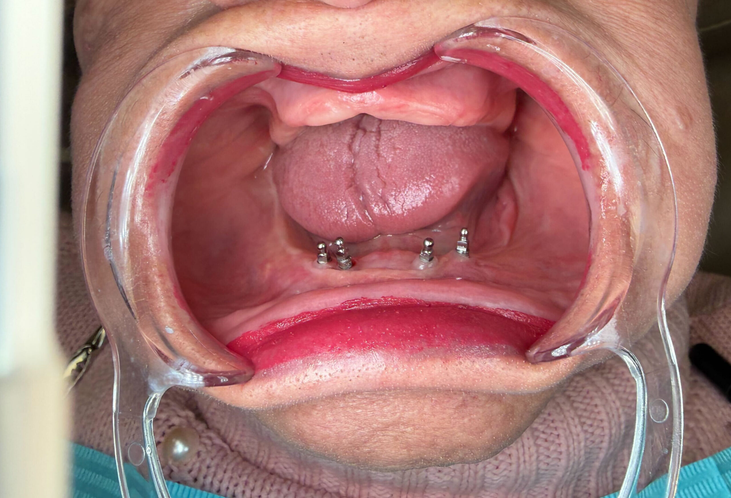 One-Piece Dental Implants in Union City, NY | How One-Piece Dental Implants Simplify Denture Stabilization