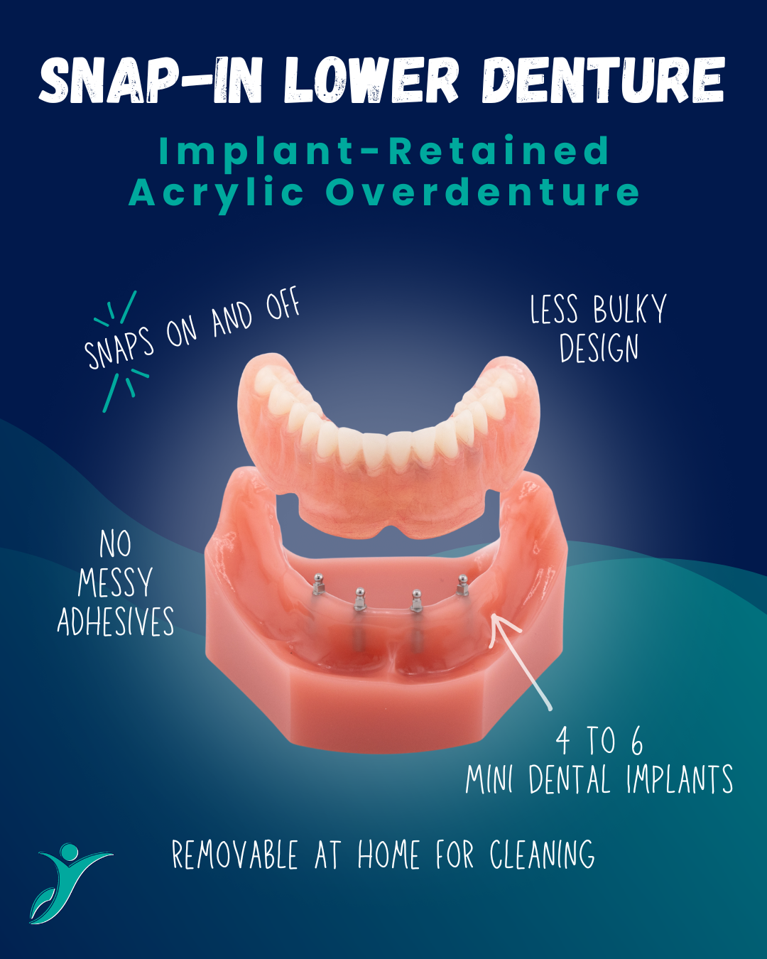 Snap-In Denture in Union City, NJ | Snap-On Lower Denture