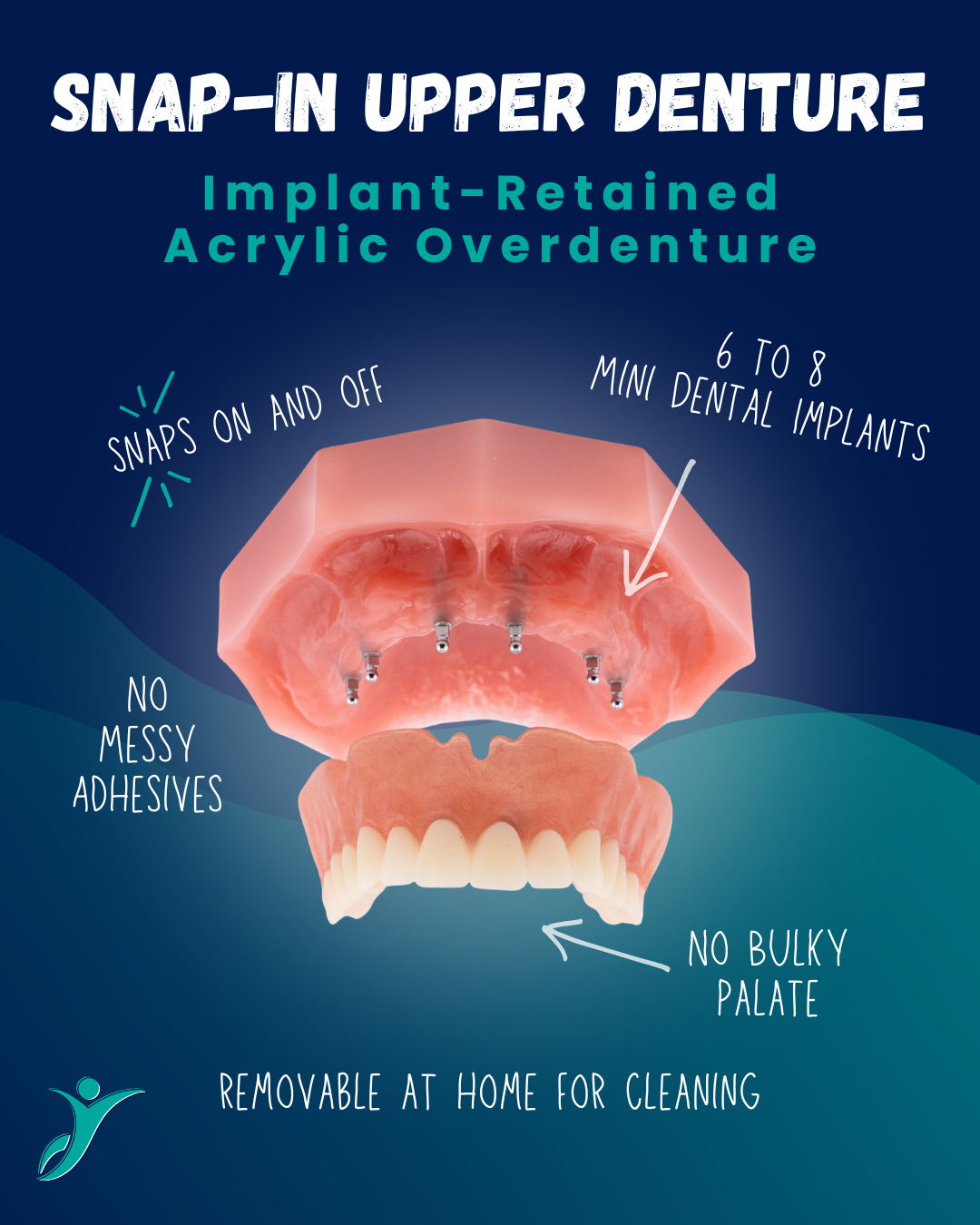 Snap-In Denture in Union City, NJ | Snap-On Upper Denture