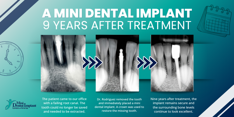 Affordable Teeth Implants in Union City, NJ | Free Consultations
