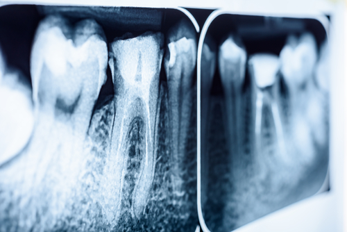 Affordable Teeth Implants in Union City, NJ | Free Consultations