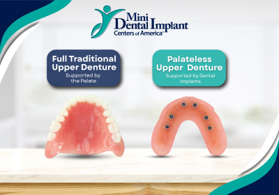 Prótesis dentales sin paladar en Union City, Nueva Jersey | Prótesis tradicionales frente a prótesis sobre implantes