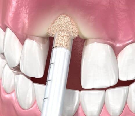 Bone Graft | Your Guide to Mini Dental Implants in Union City, NJ