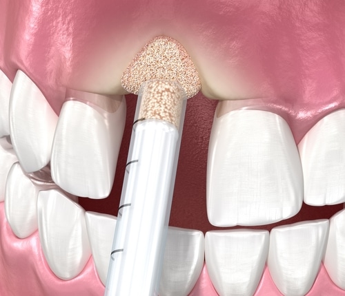 Injerto óseo | Tu guía sobre los miniimplantes dentales en Union City, Nueva Jersey