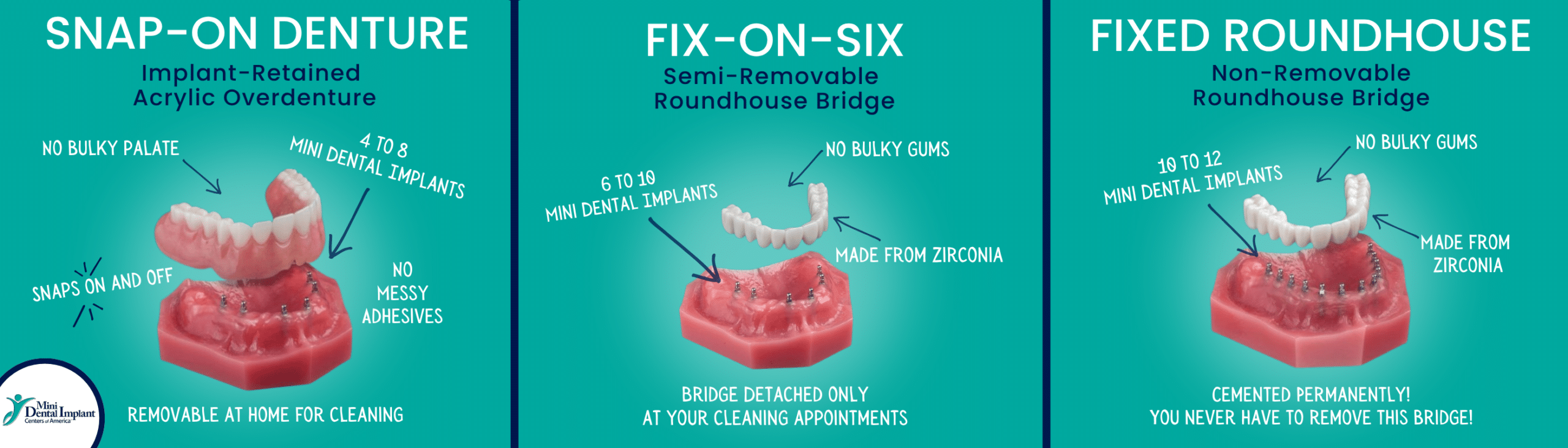 Sustitución completa de la dentadura en Union City, Nueva Jersey | Opciones de prótesis sobre implantes | ¡Reserva una consulta GRATUITA!